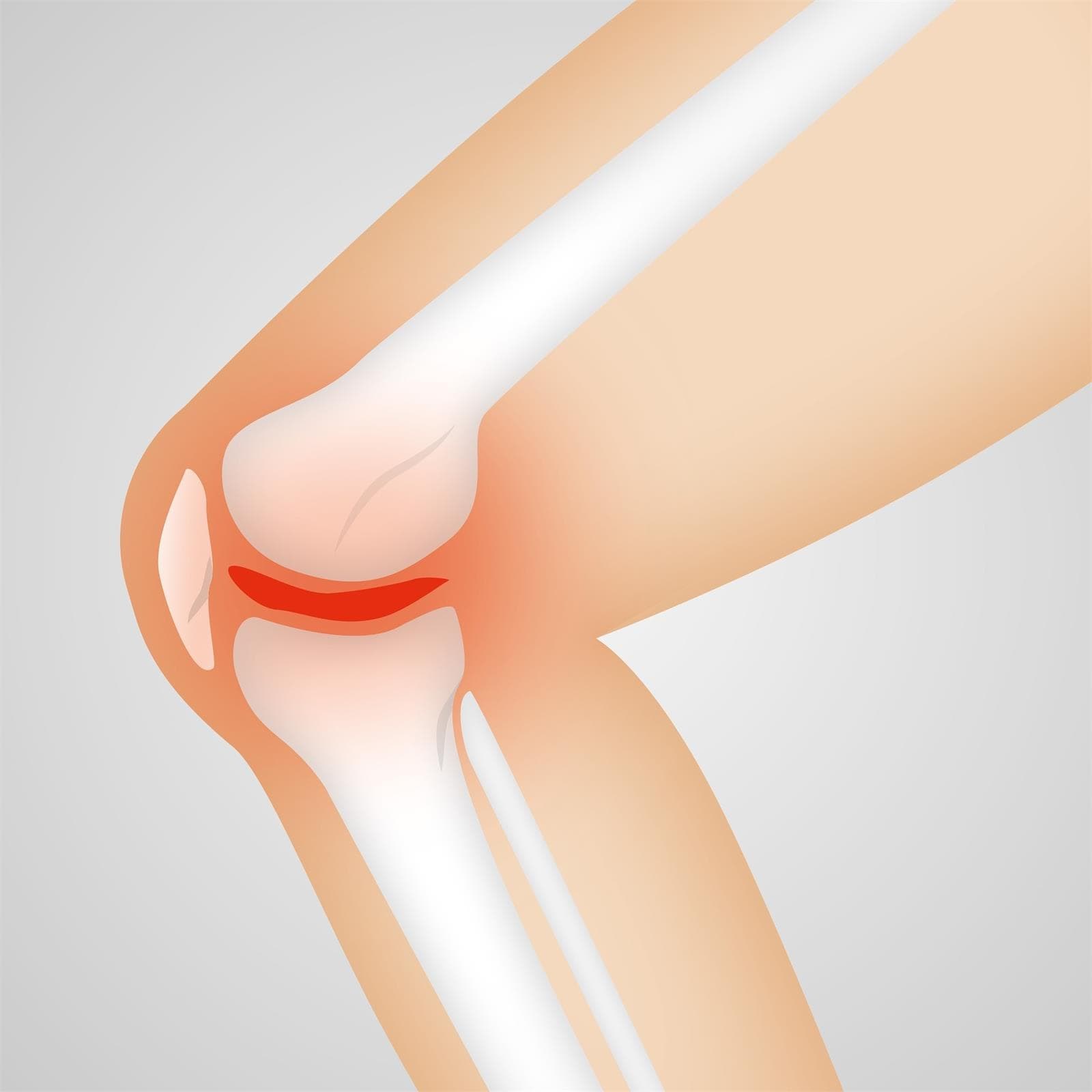 Fisioterapia para artrosis en Moaña - Imagen 1